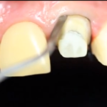 Fili di retrazione gengivale nella rilevazione di impronte dentali DM_il dentista moderno_fili di retrazione gengivale_impronte dentali