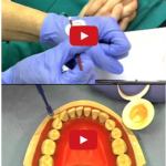 Fluoroprofilassi: una cooperazione fra il genitore e l’odontoiatra DM_il dentista moderno_fluoroprofilassi_prevenzione della carie