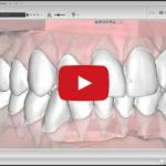 Malocclusioni: la diagnosi in ortodonzia comincia con l’analisi dentale DM_il dentista moderno_malocclusioni_diagnosi in ortodonzia