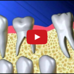 Mantenitore di spazio: preservare il leeway space DM_il dentista moderno_mantenitore di spazio_leeway space