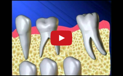 DM_il dentista moderno_mantenitore di spazio_leeway space