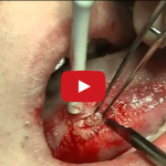 Biopsia escissionale e competenze dell’odontoiatra DM_il dentista moderno_patologia orale_biopsia escissionale_odontoiatra