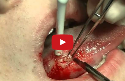 DM_il dentista moderno_patologia orale_biopsia escissionale_odontoiatra