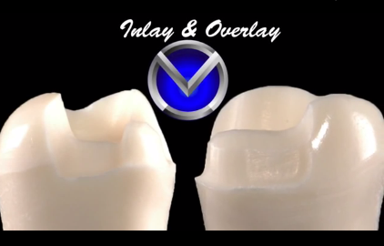 DM_il dentista moderno_restauri indiretti