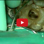 Alterazioni macro e micoscopiche nel dente devitalizzato DM_il dentista moderno_ricostruzione post endodontica dente devitalizzato 2