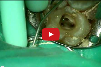 DM_il dentista moderno_ricostruzione post endodontica dente devitalizzato 2