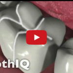 Prevenzione della carie: l’efficacia delle sigillature, il ruolo dell’odontoiatra DM_il dentista moderno_sigillature carie odontoiatra