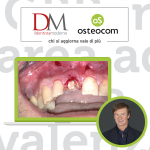 Chirurgia on demand del Prof. Simion sulla GBR nei settori estetici DM_il dentista moderno_corsi_simion