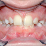 Diastema, frenulo e frenulectomia