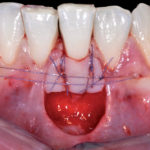 Innesti epitelio-connettivali eseguiti nell’arcata inferiore