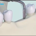 Intervento di split crest ai fini della riabilitazione implantare DM_il dentista moderno_Intervento di split crest ai fini della riabilitazione implantareDM_il dentista moderno_Intervento di split crest ai fini della riabilitazione implantare