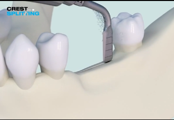 DM_il dentista moderno_Intervento di split crest ai fini della riabilitazione implantareDM_il dentista moderno_Intervento di split crest ai fini della riabilitazione implantare
