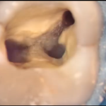 Endodonzia guidata: precisione di una tecnica per la preparazione della cavità di accesso DM_il dentista moderno_calcificazioni canalari_endodonzia