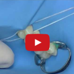 Montaggio della diga di gomma nei casi complessi DM_il dentista moderno_diga di gomma