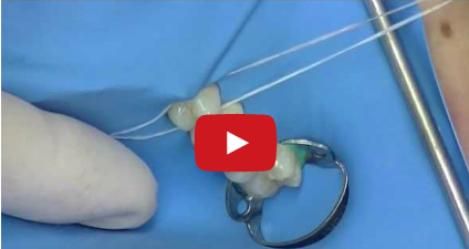 DM_il dentista moderno_diga di gomma