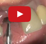 Edentulia parziale: gestione di tessuti duri e molli nelle estrazioni dentali DM_il dentista moderno_edentulia parziale_estrazioni dentali