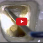 Endodonzia: l’apertura della camera pulpare DM_il dentista moderno_endodonzia apertura camera pulpare