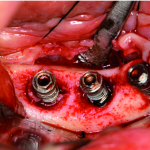 Fattori di rischio e controindicazioni al trattamento con impianti dentali DM_il dentista moderno_impianti dentali_controindicazioni relative