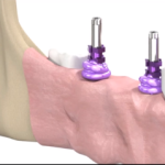 Impronta su impianti dentali: open tray technique DM_il dentista moderno_impronta su impianti dentali open tray_rischio sopravvivenza implantare