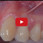 Prelievo connettivale e CAF in parodontologia DM_il dentista moderno_innesto connesttivale e CAF in parodontologia