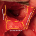 Gestione dei tessuti molli in terapia ricostruttiva di Luca De Stavola Corso_Online_Il rialzo del pavimento del seno mascellare