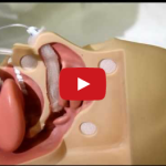 L’epistassi anteriore e posteriore in odontoiatria DM_il dentista moderno_epistassi anteriore e posteriore in odontoiatria