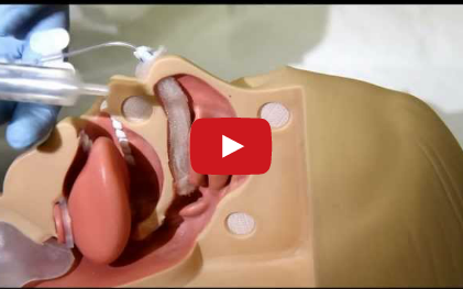 DM_il dentista moderno_epistassi anteriore e posteriore in odontoiatria