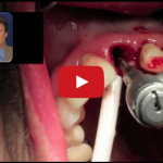 Criteri di sopravvivenza, vantaggi e svantaggi degli impianti dentali a carico immediato DM_il dentista moderno_impianti dentali carico immediato vantaggi svantaggi