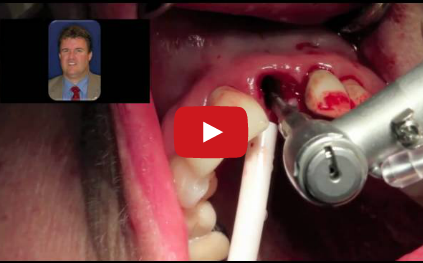 DM_il dentista moderno_impianti dentali carico immediato vantaggi svantaggi