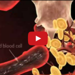 Amici di Brugg: malattia parodontale e malattie sistemiche DM_il dentista moderno_malattie sistemiche_parodontite_malattia parodontale