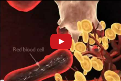 DM_il dentista moderno_malattie sistemiche_parodontite_malattia parodontale