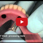 Perché preferire un overdenture su impianti ad una protesi totale? DM_il-dentista-moderno_paziente-totalmente-edentulo-protesi-totale-prima-impronta- overdenture su impianti