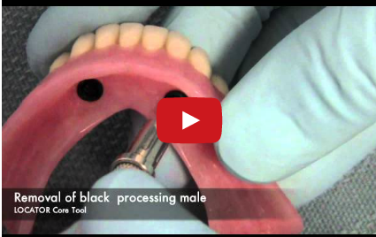 DM_il-dentista-moderno_paziente-totalmente-edentulo-protesi-totale-prima-impronta- overdenture su impianti