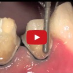 Prevenire i danni dovuti a preparazione protesica di elementi dentali DM_il dentista moderno_preparazione protesica_elementi dentali