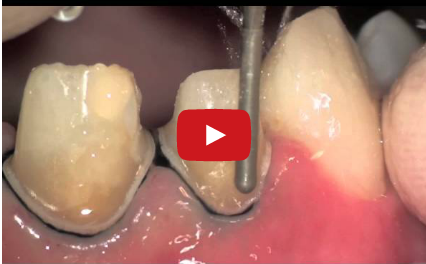 DM_il dentista moderno_preparazione protesica_elementi dentali