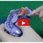 Pianificazione e rischi per una protesi supportata da impianti dentali DM_il dentista moderno_protesi su impianti dentali