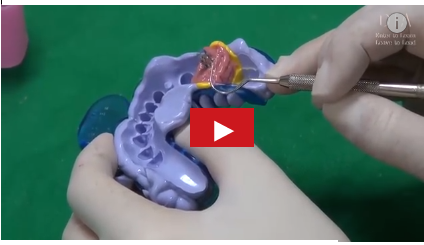 DM_il dentista moderno_protesi su impianti dentali