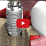 La valutazione ed il mantenimento del successo in implantologia DM_il dentista moderno_protesi su impianti_osteointegrazione_impianti dentai_implantologia