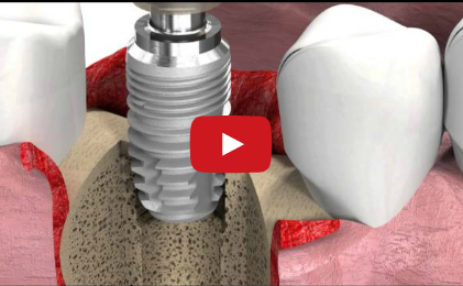 DM_il dentista moderno_protesi su impianti_osteointegrazione_impianti dentai_implantologia