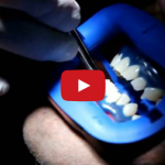 Sbiancamento dentale: indicazioni e controindicazioni al trattamento DM_il dentista moderno_sbiancamento dentale_indicazioni e controindicazioni