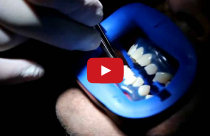 DM_il dentista moderno_sbiancamento dentale_indicazioni e controindicazioni