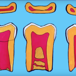Variazioni anatomiche e complicanze nella terapia canalare DM_il dentista moderno_terapia canalare_variazioni anatomiche complicanze
