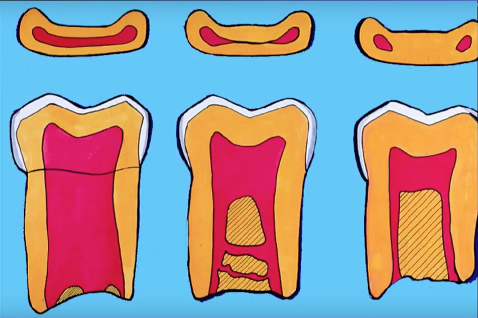 DM_il dentista moderno_terapia canalare_variazioni anatomiche complicanze