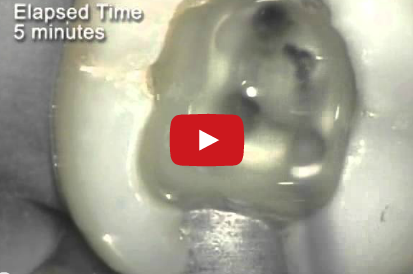 DM_il dentista moderno_terapia endodontica_irriganti_naclo_EDTA