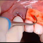 Estetica e implantologia: difficoltà e complicanze nelle gestione dei tessuti molli DM_il dentista moderno_ implantologia_estetica_ complicanze_gestione dei tessuti molli