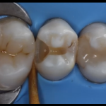 Una ricostruzione di seconda classe di Black in un secondo premolare DM_il dentista moderno_ seconda classe di Black_premolare