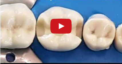 DM_il dentista moderno_Criteri realizzativi e preparazione cavitaria per intarsi