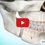 LeFort I e uvulopalatofaringoplastica nel trattamento chirurgico delle OSAS DM_il dentista moderno_LeFort I e uvulopalatofaringoplastica nel trattamento chirurgicp delle OSAS