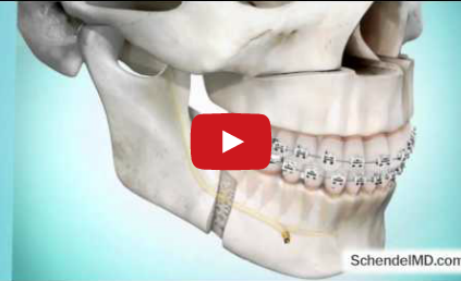 DM_il dentista moderno_LeFort I e uvulopalatofaringoplastica nel trattamento chirurgicp delle OSAS