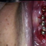 Perimplantite: approccio chirurgico e protesico DM_il dentista moderno_Perimplantite approccio chirurgico e protesico